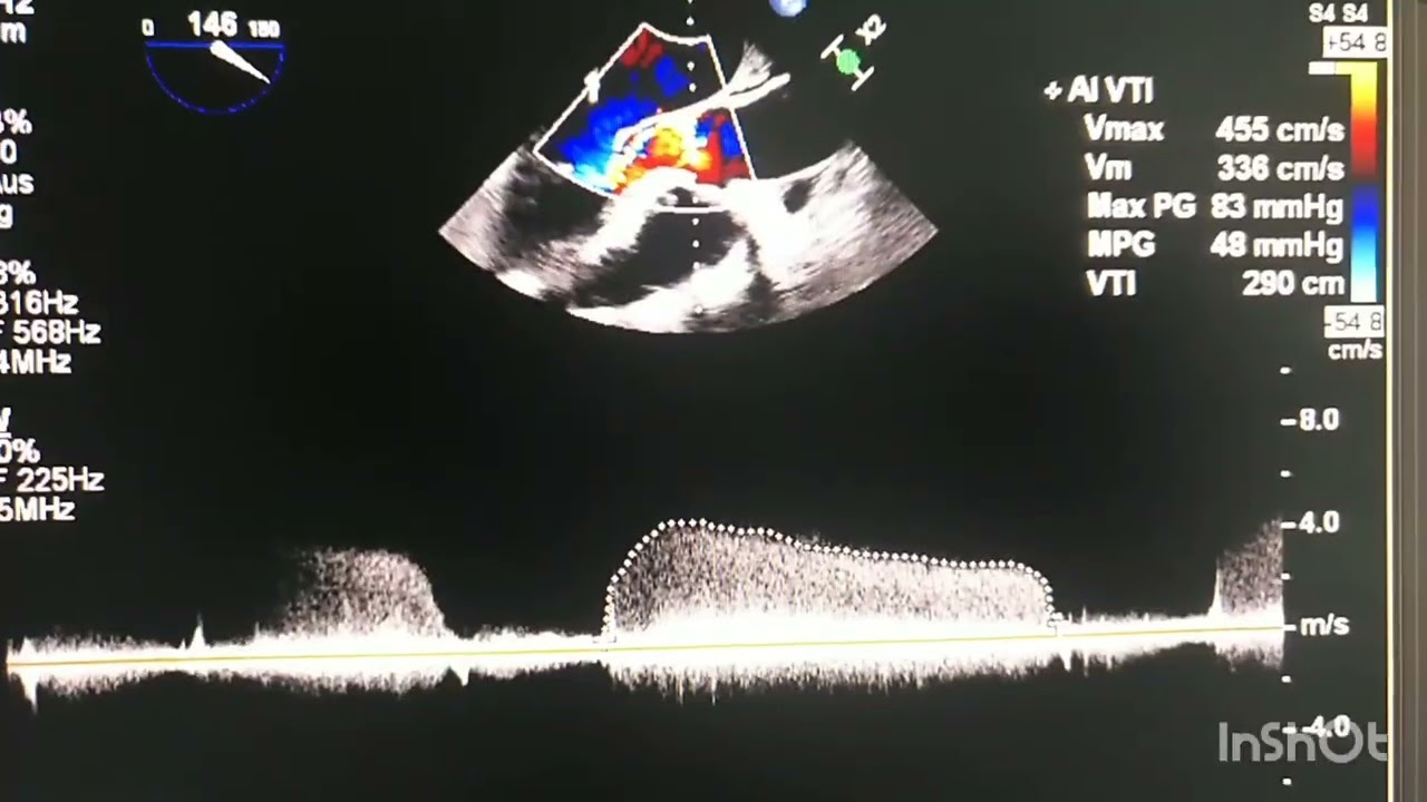 severely eccentric aortic regurgitation quantified with PISA method ...