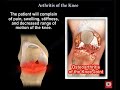 Knee Pain , knee Arthritis. what is knee arthritis ?