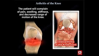 Knee Pain , knee Arthritis. what is knee arthritis ?