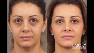 Facts About Fillers