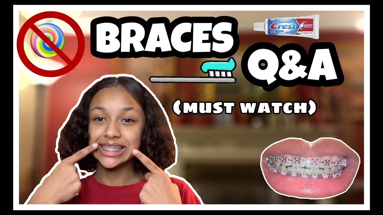 BRACES Q&A THINGS YOU NEED TO KNOW BEFORE GETTING BRACES! 🦷 Questions ...