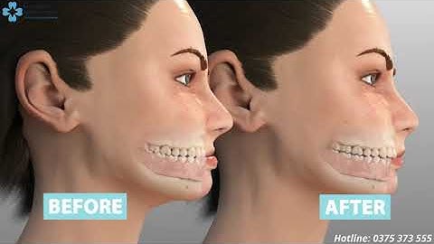 Khớp cắn ngược là gì? Điều này có hại không?