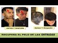 COMO HACER CRECER EL PELO DE LAS ENTRADAS SI FUNCIONA