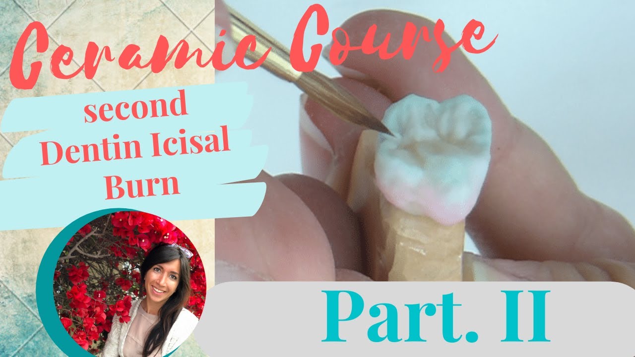 Dental Ceramic Layering Second Dentin Incisal Burn with HeraCeram