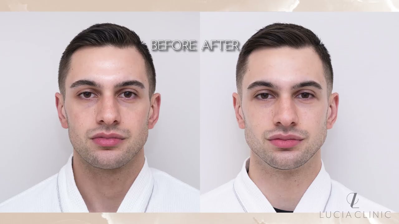 Botox with Dermal Fillers : perfect combination for natural beauty