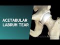 Acetabular Labrum Tear Pathologies 