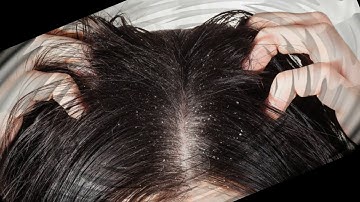 ★머리에 이가 및 니트를 제거하는 방법. 머릿니 치료. 이가 효과적인 약물.