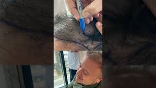 ?الحل النهائي لجميع حالات الصلع الوراثي زراعة الشعر مع مشفى إليت هير