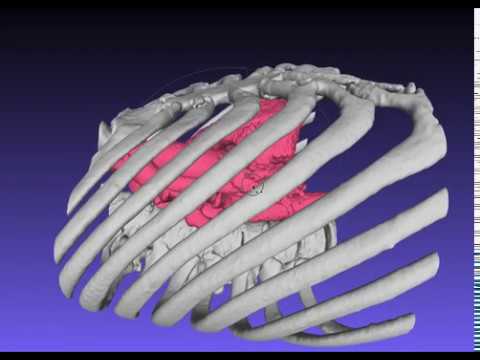 MICS（Simulation of minimally invasive mitral valve replacement） - YouTube