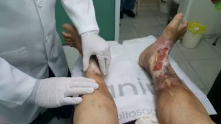 La úlcera pierna de tratamiento la de vía venosa de