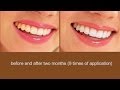 WHITENING  teeth at home