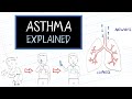 What is asthma healthsketch