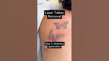Laser Tattoo Removal 