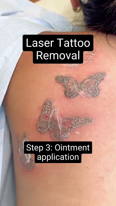 Laser Tattoo Removal