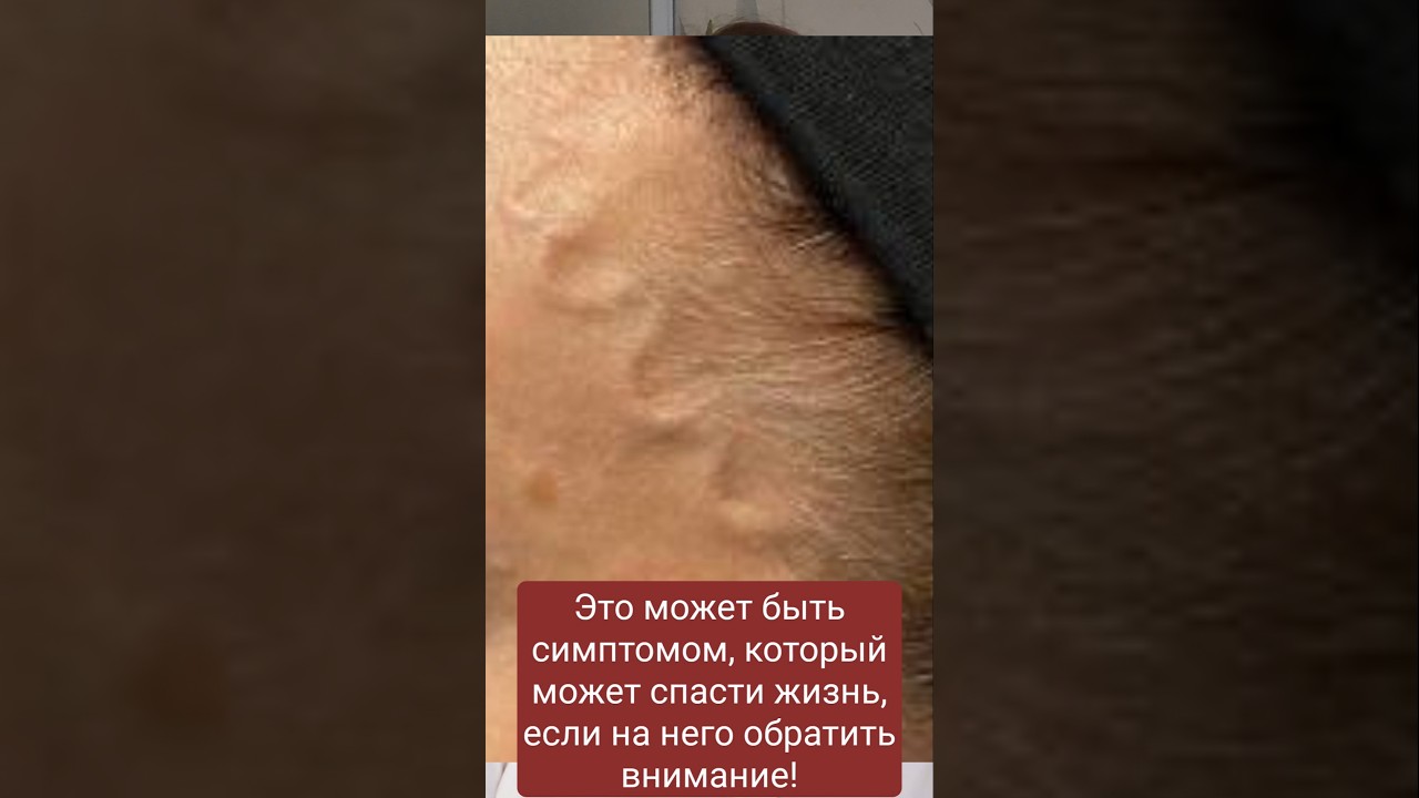 Выпуклые сосуды на висках? Срочно проверьте сосуды! Признаки атеросклероза.