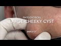 Large Cheeky Cyst pops over my head and splatters me. Large face cyst excision with 1 wk follow up.