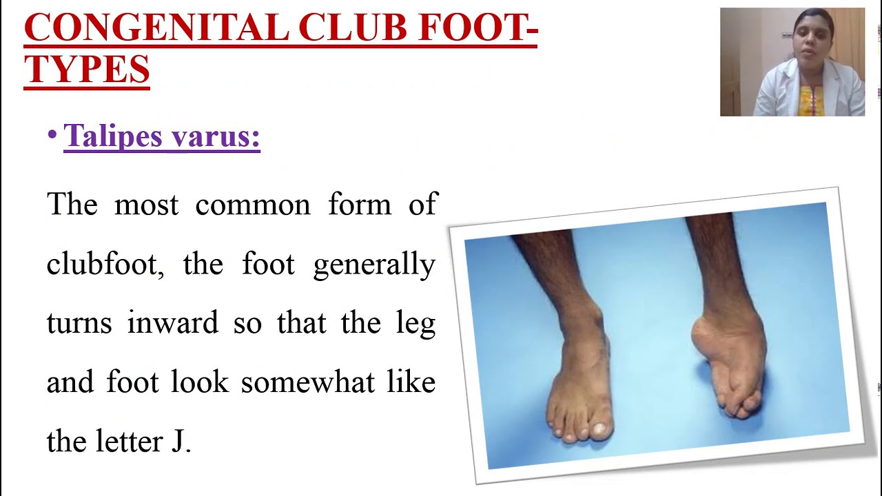Congenital Club Foot In Child Kerala Nurses Hub Youtube