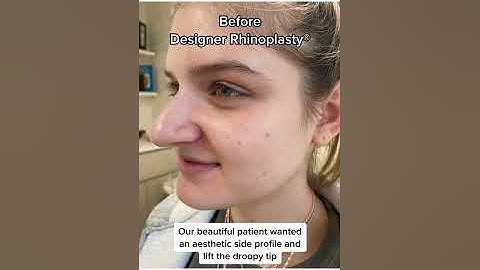 6 months after Designer Rhinoplasty® #nosejob #bestnosejob #rhinoplastysurgeon #nycplasticsurgeon
