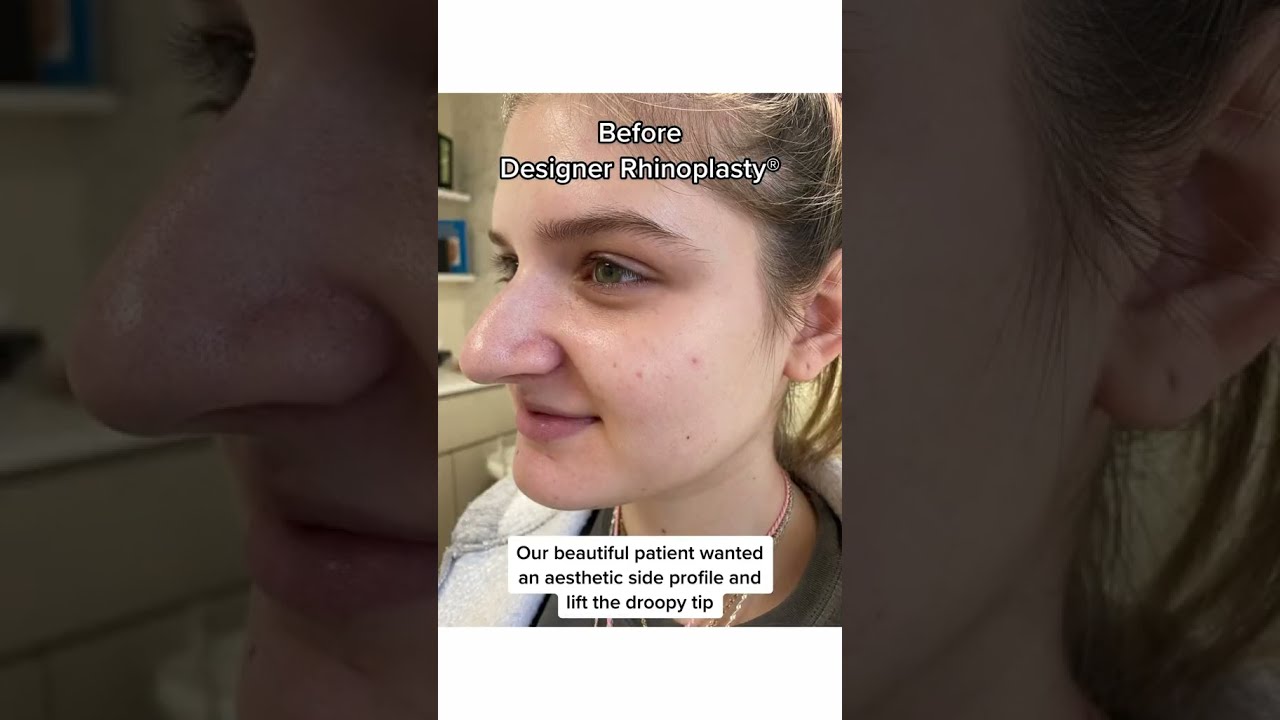 6 Months After Designer Rhinoplasty Nosejob Bestnosejob Rhinoplastysurgeon Nycplasticsurgeon
