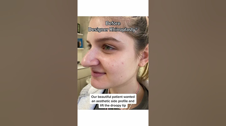 6 months after Designer Rhinoplasty® #nosejob #bestnosejob #rhinoplastysurgeon #nycplasticsurgeon