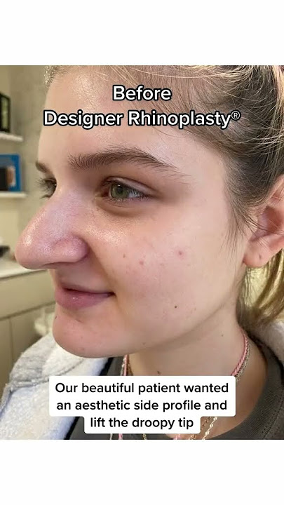 6 months after Designer Rhinoplasty® #nosejob #bestnosejob #rhinoplastysurgeon #nycplasticsurgeon