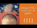 Chirurgie fue  nombre lev de greffons  aperu avec bisanga pisode 40  clinique bhr