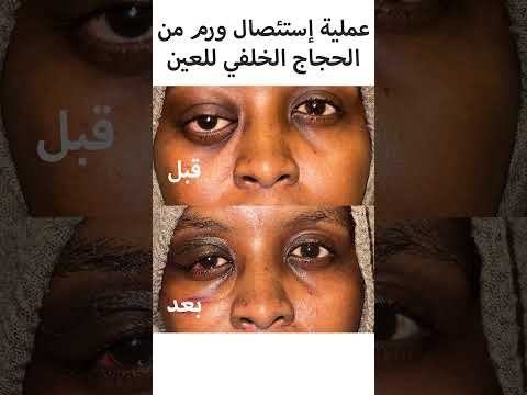 كيف أعرف أن لدي ورم في حجاج العين؟