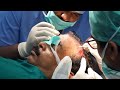 Advanced Hair Transplant surgery 2020- Step by Step Procedure, Before and After