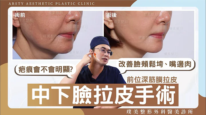 中下臉拉皮疤痕很可怕？解析最新臉鬆秘密武器！前位深筋膜拉皮手術原理、效果及疤痕隱微漂亮的原因 - 天天要聞
