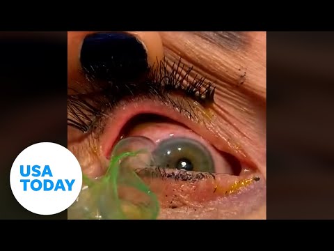 Eye doctor pulls 23 contact lenses from elderly woman's eyelid | USA TODAY