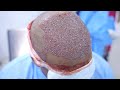 FUE Hair Transplant Planning &amp; Marking in India