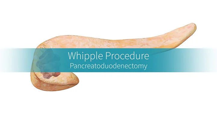 Whipple Procedure: Why and How the Surgery Is Performed