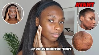 Skincare Routine Simple Contre Les Boutons Et Les Tâches Acne Skincare Routine