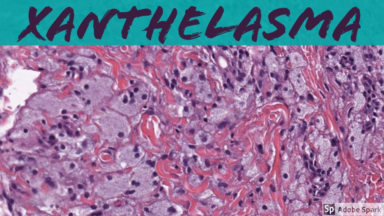 Xanthelasma (Xanthoma of Eyelid): 5-Minute Pathology Pearls