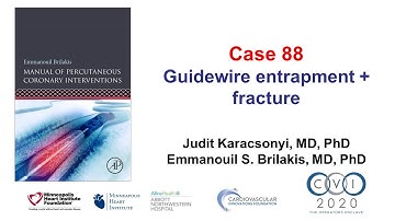 Case 88: PCI Manual - Wire entrapment and fracture