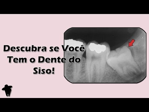 Vídeo: Quantos dentes do siso existem?