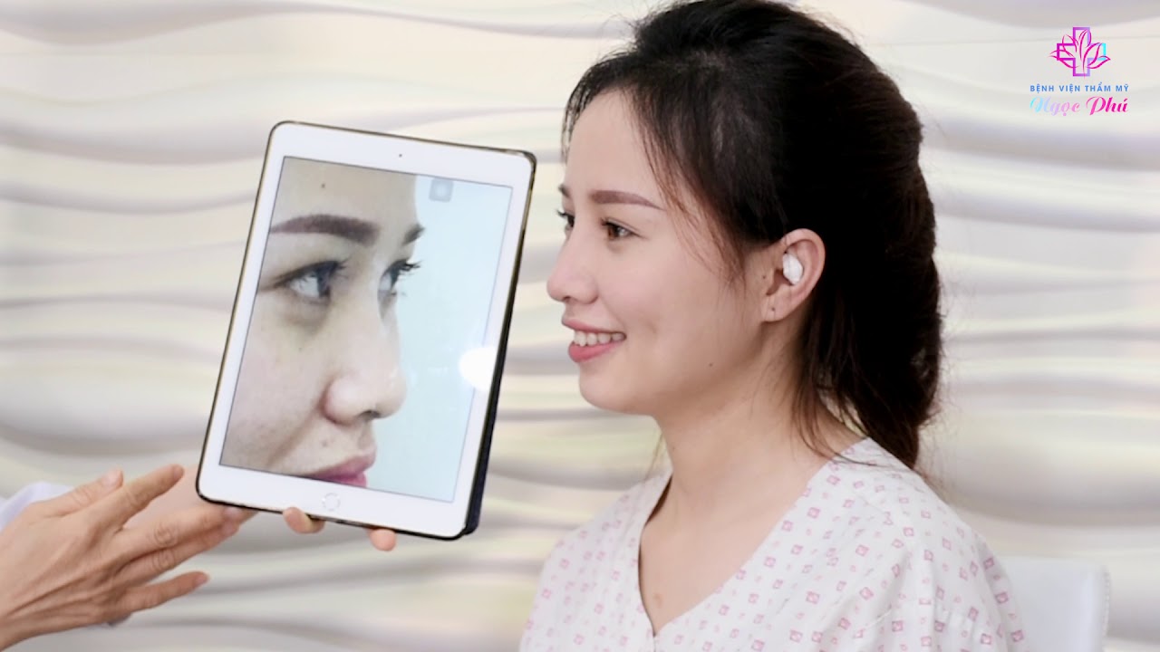 bảng giá thẩm mỹ viện ngọc phú 2022 Update Khách hàng Nâng mũi Bọc sụn tại Bệnh viện Thẩm mỹ Ngọc Phú