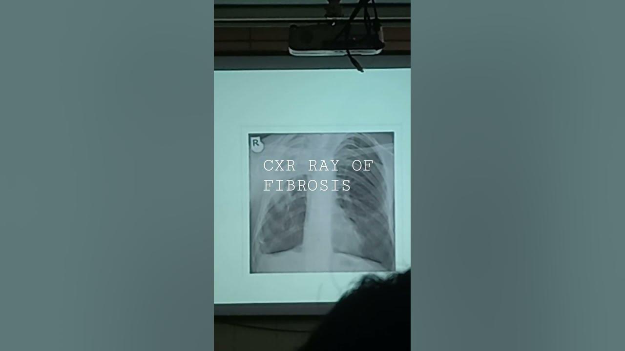 x-ray-of-right-upper-lobe-fibrosis-youtube