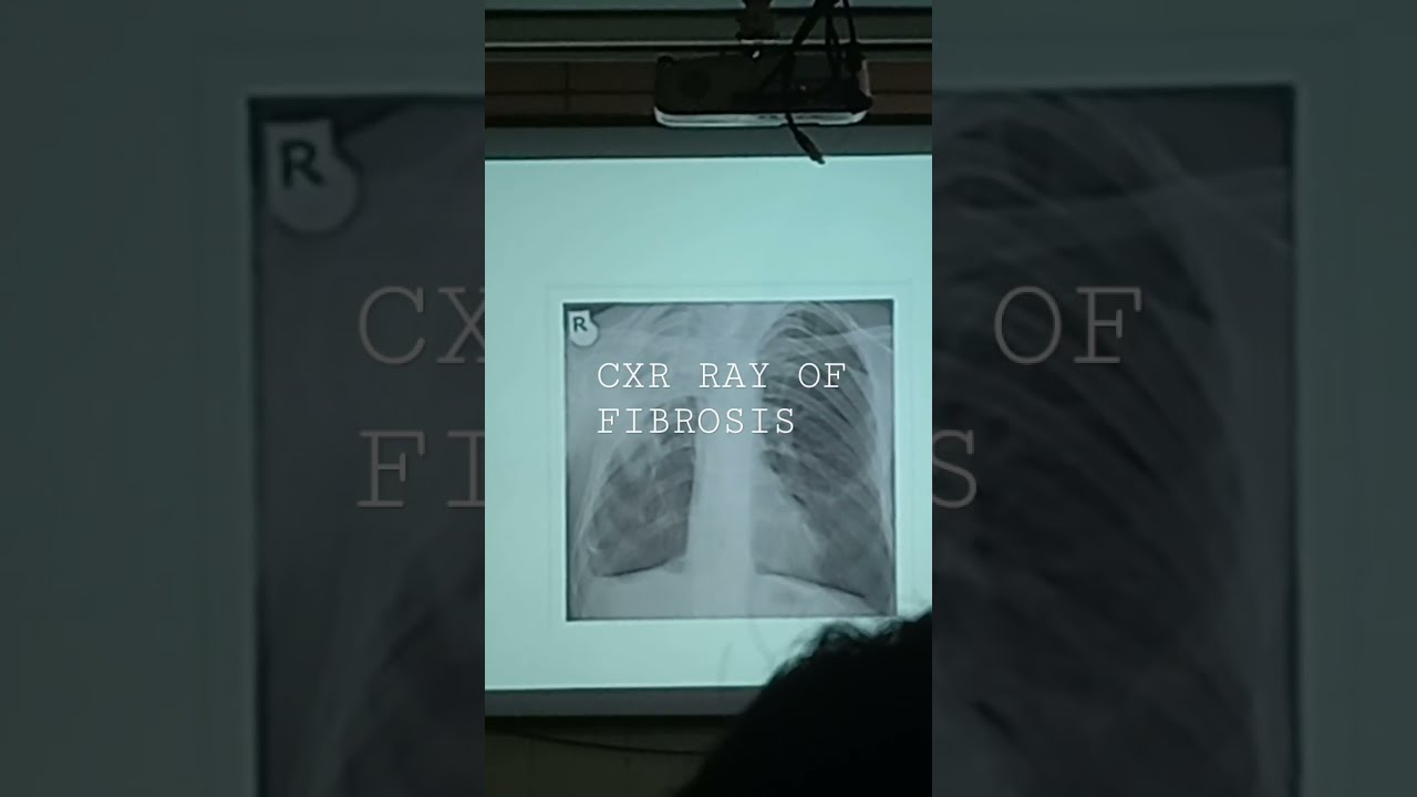 X Ray Of Right Upper Lobe Fibrosis YouTube X Ray Of Right Upper Lobe Fibrosis YouTube