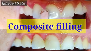 class IV Composite filling of interior teeth || world strongest filling || composite filling...