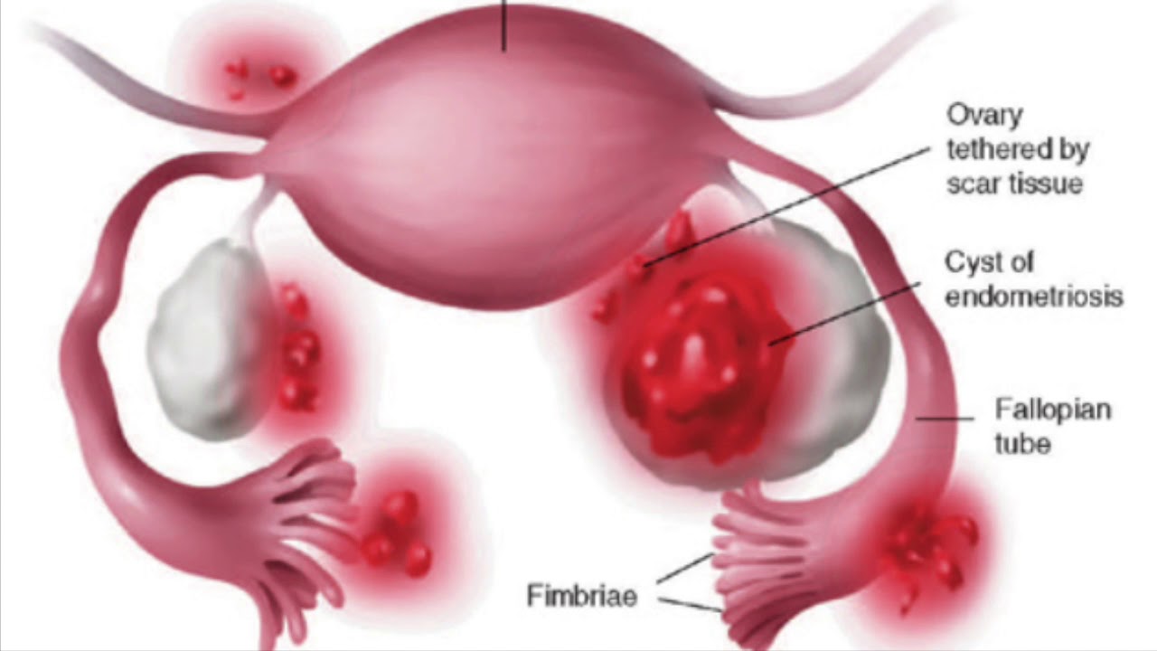 endometriosis and birth control YouTube endometriosis and birth control YouTube
