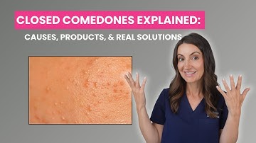 How to Get Rid of Closed Comedones | Dermatologist Explains Whiteheads & Bumpy Skin