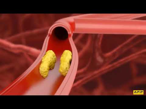 Ангиопластика - Анимированное видео