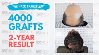 Manual FUE Hair Transplant Before & After 4000 Grafts 2-Year Result - ASMED - Dr. Koray Erdogan