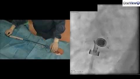 Pacemaker Leadless Micra VR implant