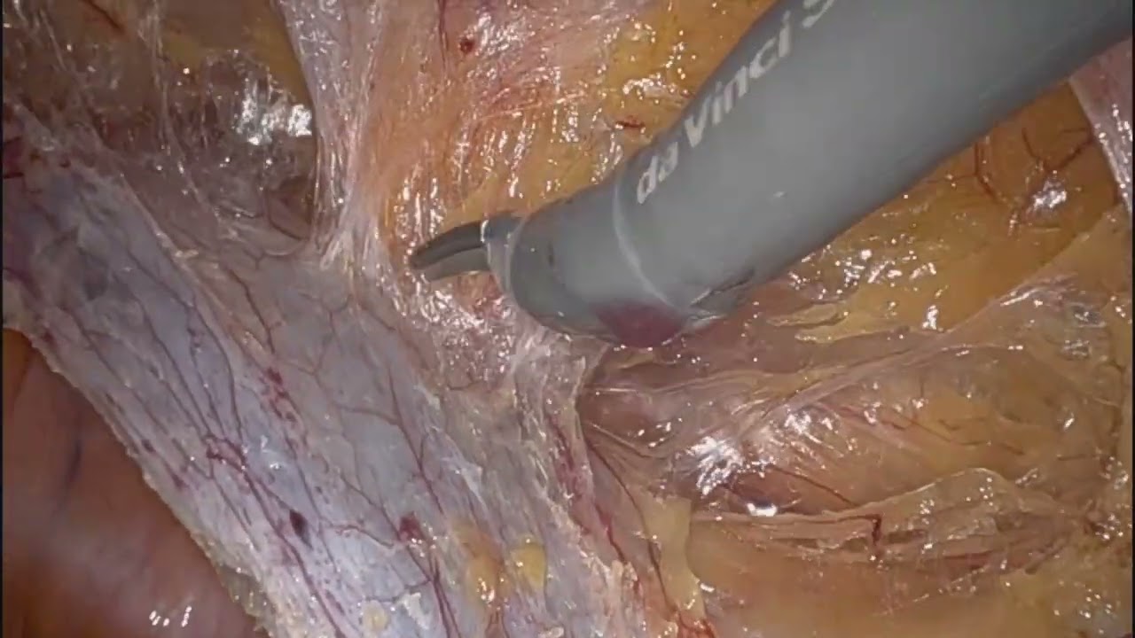 Robotic Repair of Bilateral Inguinal Hernias - Direct - YouTube