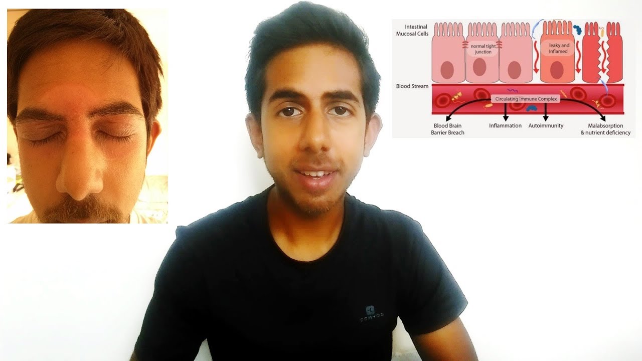 What is Leaky Gut Syndrome? | How to Heal Eczema 