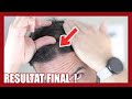 MA 2ème GREFFE DE CHEVEUX : Résultat final !