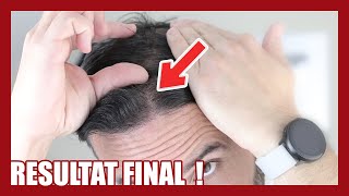 MA 2ème GREFFE DE CHEVEUX : Résultat final !