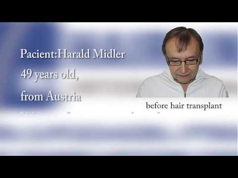 Hairline International - ერთერთი ჩვენი პაციენტი One of our patients(Harald Midler)